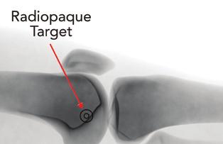 Note: This initial targeting step assists with planning the general location of the femoral incision.