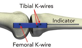 Create a tissue tunnel using blunt dissection between the two incisions.