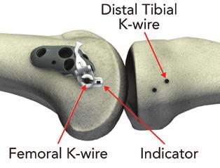 Fix Femoral Base Place the Femoral Base over the target femoral K-wire.