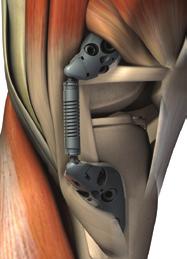 The two K-wires will help maintain correct Absorber positioning parallel to the tibial shaft.