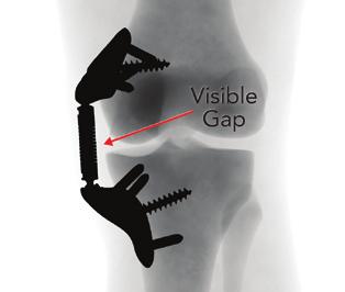 The anterior edge of the Tibial Base and the Absorber should remain parallel to the tibial shaft.