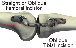 Tips for Obtaining True Lateral View Manage the hip/thigh to obtain true lateral views; manipulating the foot may inadvertently rotate the tibia and result in sub-optimal device placement Obtain true