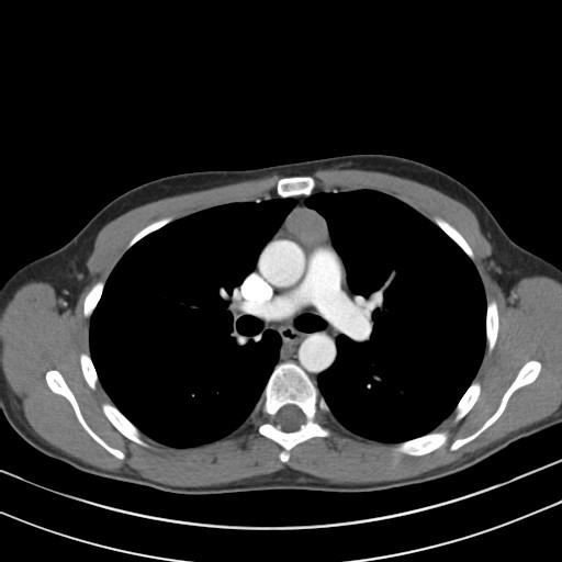 Our patient: Anterior mediastinal mass on axial chest CT Oval shaped anterior mediastinal mass, 2.