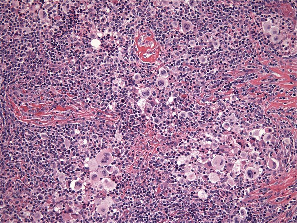 Our patient: microscopic histopathology Image courtesy of Dr Kevin Long, BWH Pathology Pathology: Multiple CD15+CD30+ Reed-Sternberg cells, with prominent