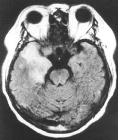 Companion patient 1: HSV encephalitis on axial MRI Asymmetric lesions Associated hemorrhage Fever in >90% of