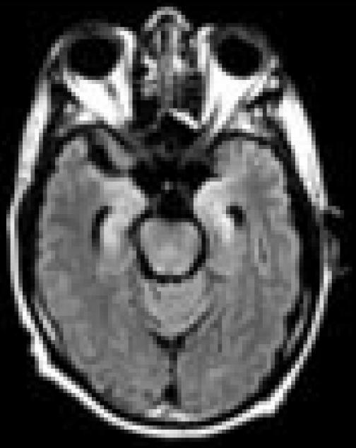 Companion patient 2: HHV6 encephalitis on axial MRI HHV6 causes limbic encephalitis with anterograde amnesia and temporal lobe MRI abnormalities Disease seen