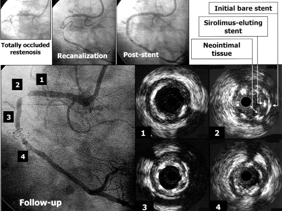 Fig. 2 Serial angiograms in a patient with restenosis that caused total occlusion of the right coronary artery, subsequently treated with a sirolimus-eluting stent.