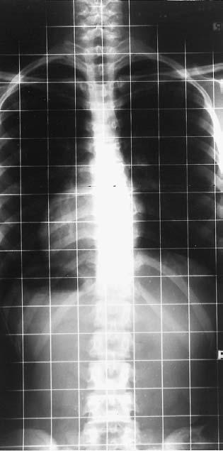 IDIOPATHIC SCOLIOSIS IN TWINS 215 Radiographs of 13-year-old female