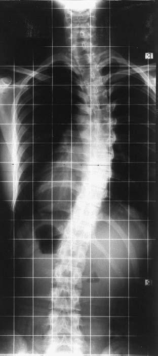The girl with no scoliosis was shorter and had not reached the