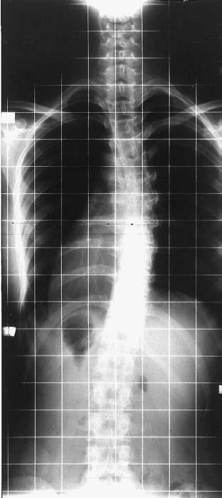2b Radiographs of 16-year-old female dizygotic twins concordant for