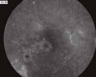 Significant visual loss in patients with intraocular inflammation is most commonly a consequence of cystoid macular edema (CME).