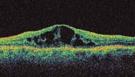 2 It is now a recognized complication associated with a number of ocular diseases, such as uveitis, retinitis pigmentosa, diabetic retinopathy, and retinal vein occlusions.