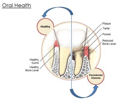 Oral Health Say: Some individuals with diabetes may also be prone to gum disease. This has to do with the effects on circulation, which we talked about earlier.