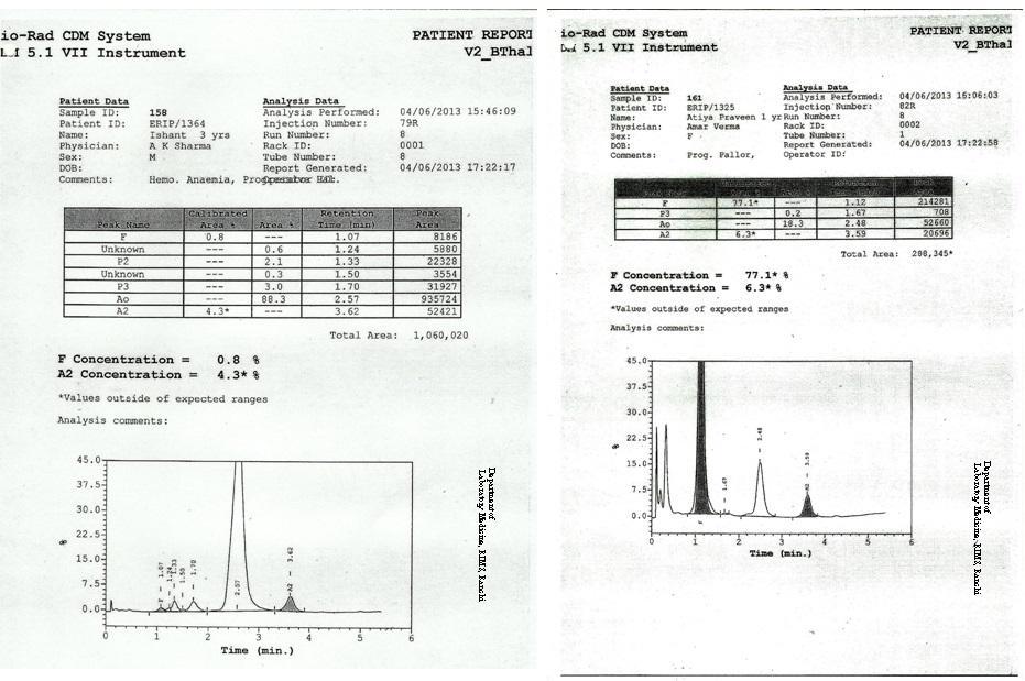 Department of Laboratory Medicine, RIMS Figure - 7 Chromatogram of our study Spectrum of Thalassemia & Sickle cell anemia B Thal Trait, 13 db Thal Trait, 9 Sickle Homo, 12 Sickle Thal, 7 HPFH Trait,