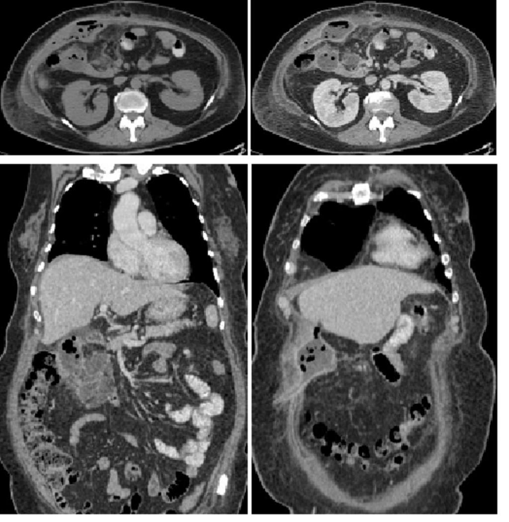 Fig. 2: Subhepatic abscesses - fluid collections with