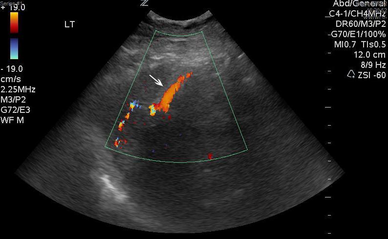Figure 2: 87 y/o female with hematochezia. Progressive images of a SMA arteriogram demonstrating prominent ileal varices in the right lower quadrant (arrows) on the venous phase.