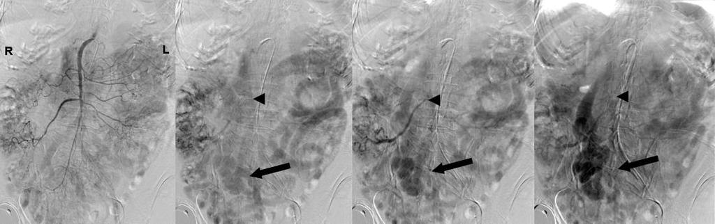Notice how the contrast enhancement of the varix increases throughout the course of the study and is most intense on the last frame of the angiogram.