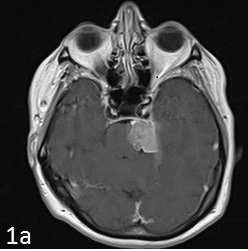 Romanian Neurosurgery (2015) XXIX (XXII) 1: 27-37 29 Results There were 4 (36.37%) sphenopetroclival meningiomas and 7 (63.67%) petroclival meningiomas.