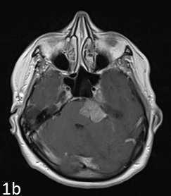 Macroscopically complete removal of the petroclival meningioma, Simpson grade I to III, was achieved in 5 out of 11 cases, as follows: grade I 1 patient, grade II 3 patients and grade III 1 patient