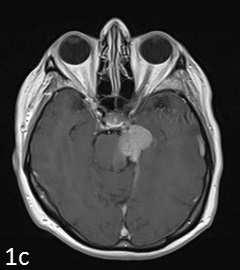 Most frequently encountered early surgical complication were related to cranial nerve paresis (ophthalmic paresis, facial paresis, hearing loss and IX, X cranial nerve deficits).