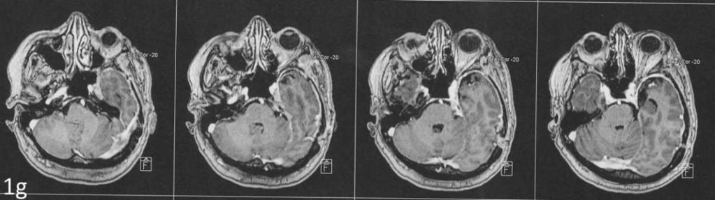 cranial nerve palsy and left trigeminal neuralgia; (g,