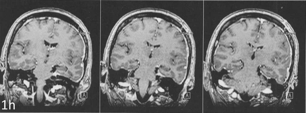 MRI images after total resection of the meinigioma