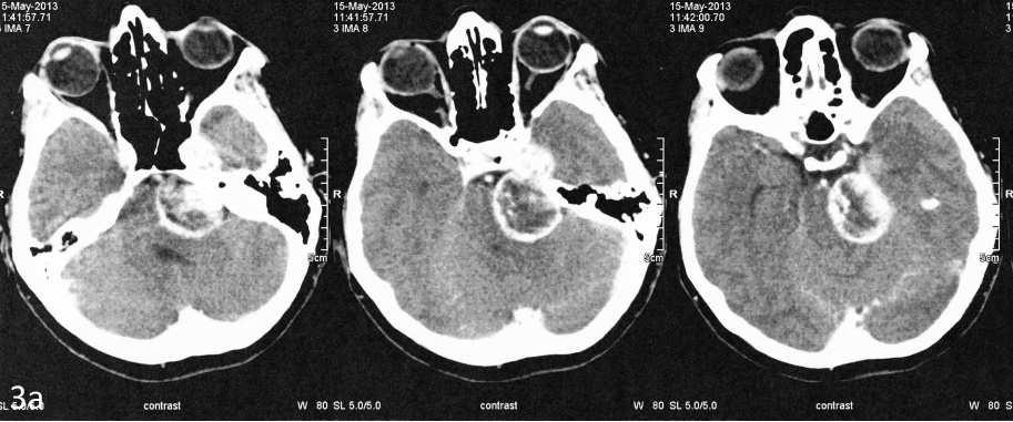 32 Radoi et al Surgery of petroclival meningiomas Figure 3 (a) Preoperative contrast cerebral CT scan showed a petroclival