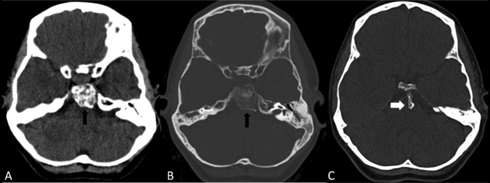 Introduction Osteochondromas are benign bone tumors of mesenchymal and non mesenchymal types (1). Their presentation as intracranial mass is a very rare phenomenon (2). The incidence is only 0.1-0.