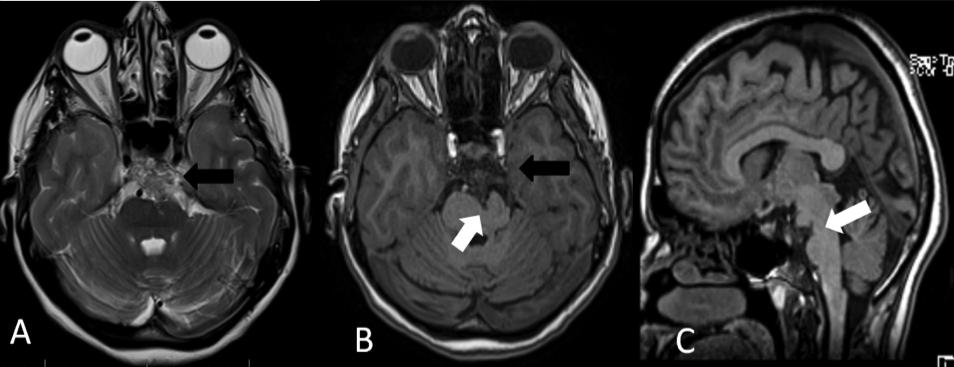 Osteochondroma of Clivus; An Unusual Cause of Headache The lesion was causing slight lateral displacement of basilar artery without any encasement or compression.