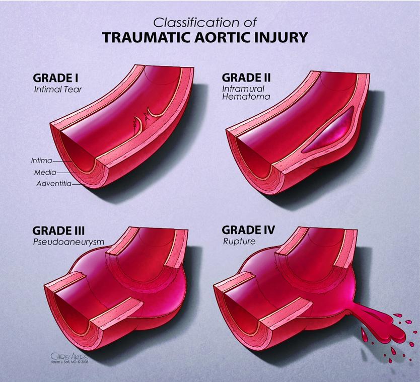 1404 Azizzadeh et al JOURNAL OF VASCULAR SURGERY June 2009 Fig 1. Classification system for traumatic aortic injury. doaneurysm; and grade 4, free rupture.