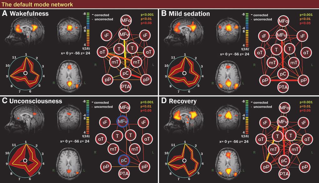 276 GULDENMUND ET AL. FIG. 1. Default mode network (DMN) integrity during wakefulness, mild sedation, unconsciousness, and recovery.