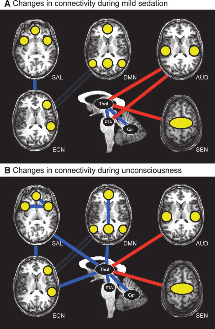 PROPOFOL-INDUCED BRAIN CONNECTIVITY CHANGES 281 the PTA in the ascending reticular arousal system is well illustrated in the case of brainstem coma, a state in which there is a total absence of brain