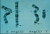 Genetic disorders of repeats Fragile X syndrome most common