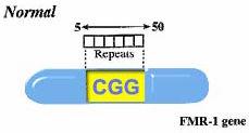 mutation of FMR1 gene causing many repeats of CGG triplet in