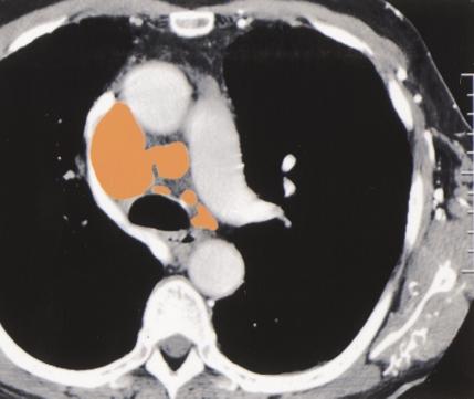 65-year-old man with small cell lung carcinoma and superior vena cava syndrome.