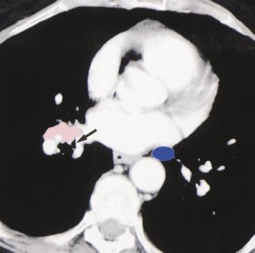 , ontrast-enhanced T scan shows station 8 paraesophageal node.