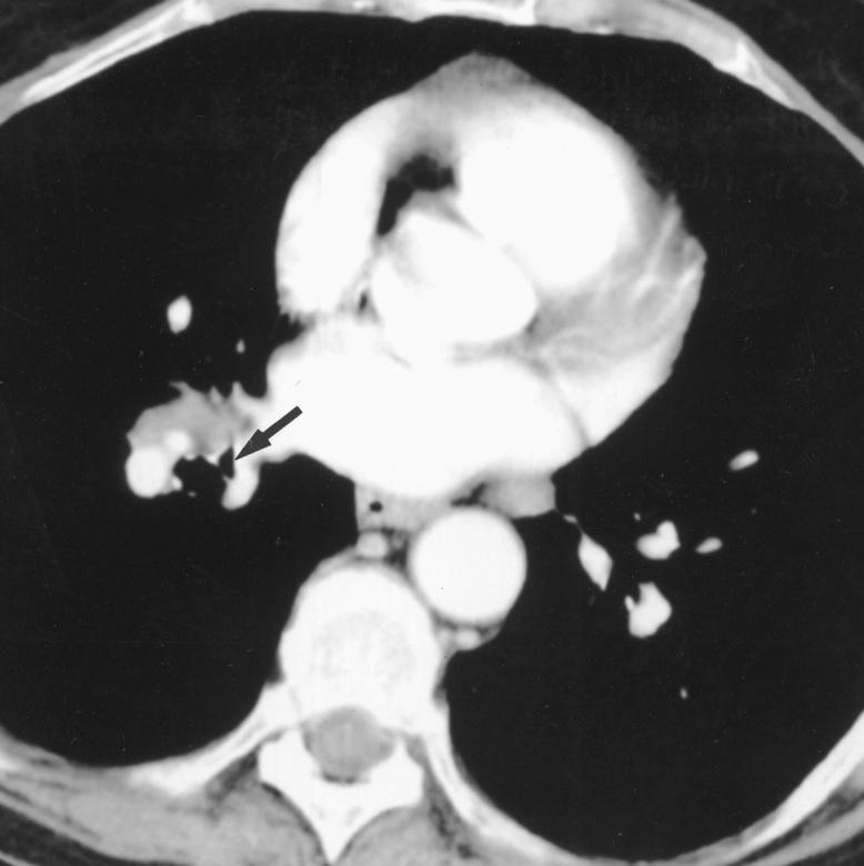 arrow). Fig. 12. 66-year-old woman with adenopathy.