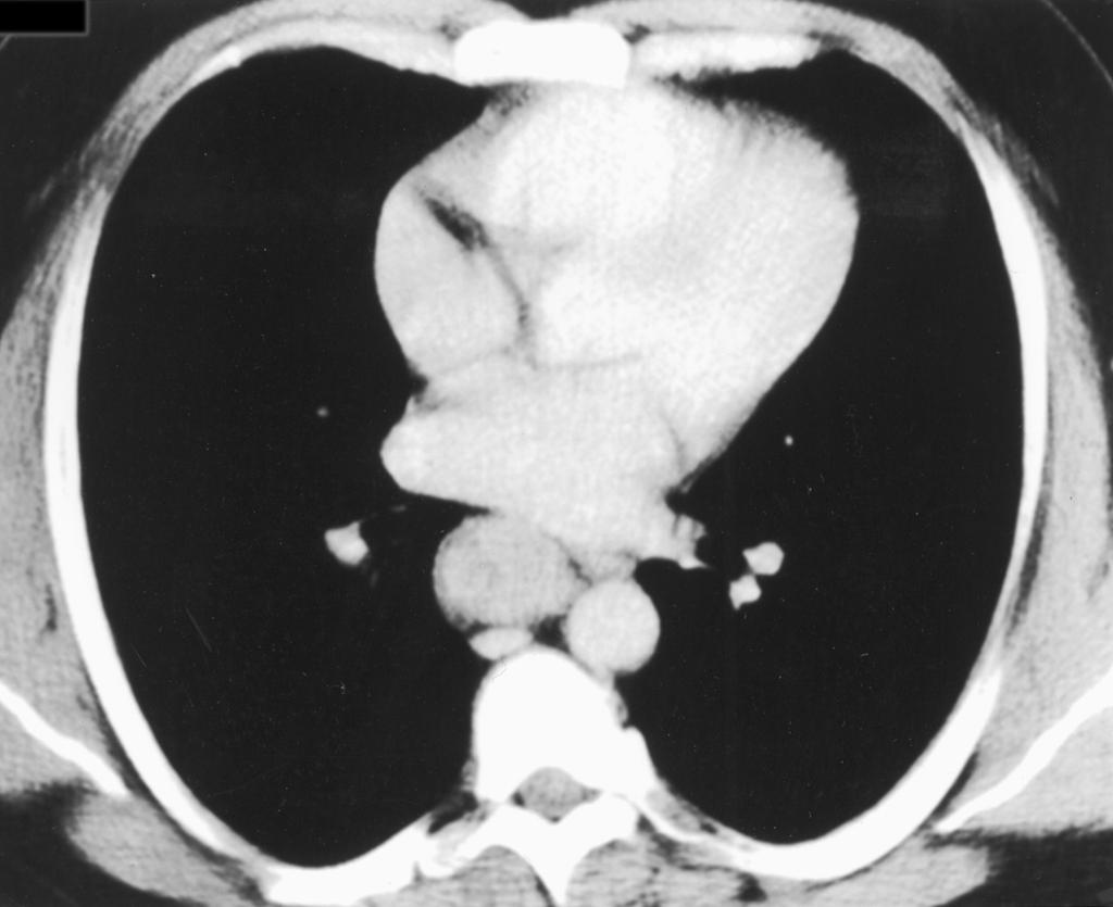 , Same scan as and viewed with lung window settings shows inferior pulmonary ligament (white arrows) adjacent to node (black arrow).