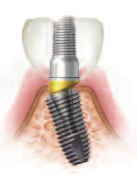 screw abutment retained prosthesis enables easy retrieval.