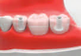 <Using Plastic Abutment> Considering the opposing teeth before seating the temporary abutment,