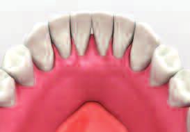 After setting, remove denture from the mouth.