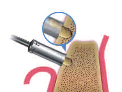 Available drill stopper helps control drill depth for safe and efficient bone collection, especially in the buccal side of ridge.