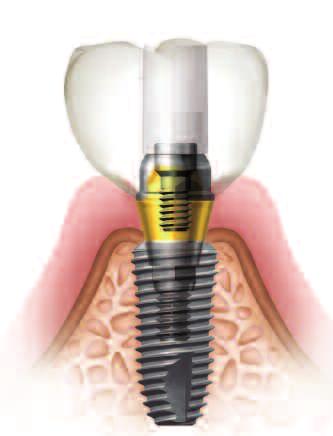 18 SuperLine & Implantium Surgical / Prosthesis Manual Screw Abutment Screw Abutment Angled Screw Abutment If
