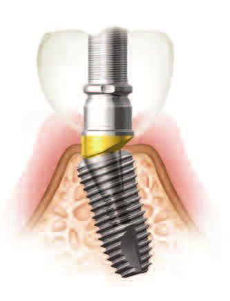 Useful for connecting multiple units or if there is a preference for a screw retained prosthesis.