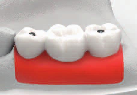 In that case it is advised to apply occlusal load on the prosthesis for 10~15 minutes.