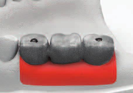 with opposing teeth, then trim cylinder to its appropriate height Connect