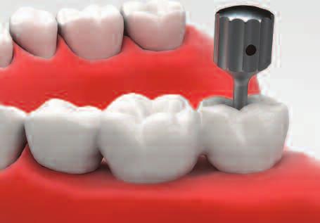 However the weak point is that it cannot be removed after permanent cementation.
