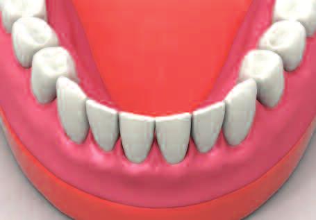 the denture and apply resin around