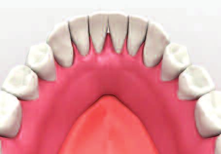 Position the denture into the mouth