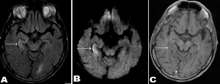 degeneration and sensory neuropathy. Paraneoplastic limbic encephalitis have frequently been described in patients with lung cancer, breast cancer, gynecological and hematological malignancies.